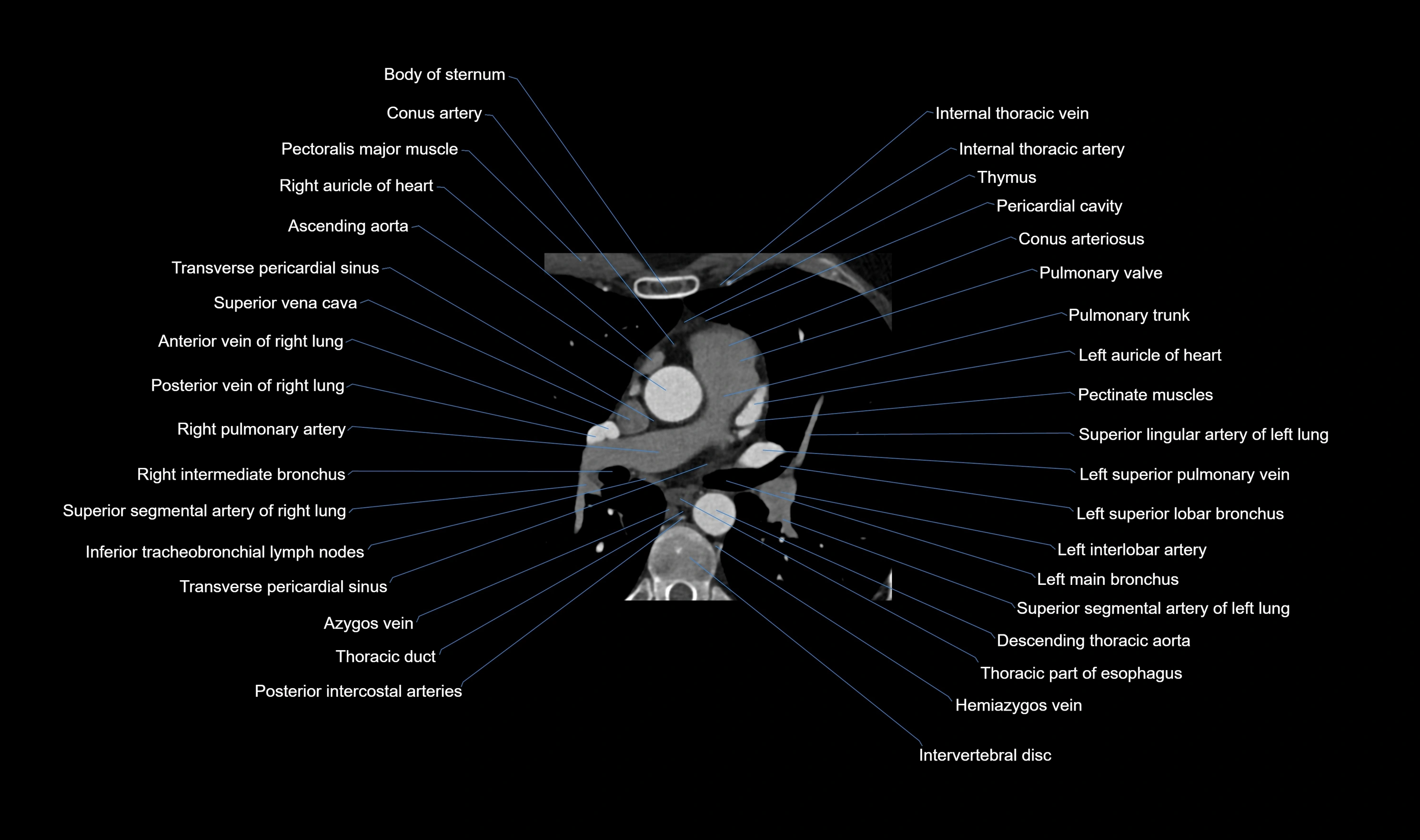 CT heart (coronary angiogram) axial view cross sectional anatomy labelled radiology image-00017.webp